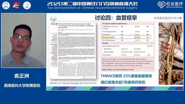 西南医大附院脑卒中团队袁正洲博士再次斩获全国冠军！