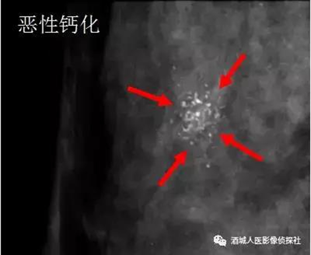 钼靶、超声、磁共振...筛查早期乳腺癌到底该选啥？(图2)