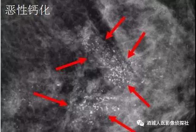 钼靶、超声、磁共振...筛查早期乳腺癌到底该选啥？