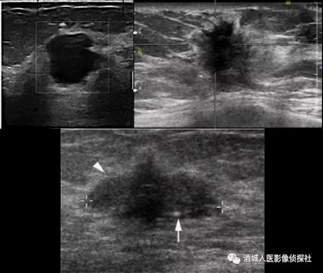 钼靶、超声、磁共振...筛查早期乳腺癌到底该选啥？(图3)