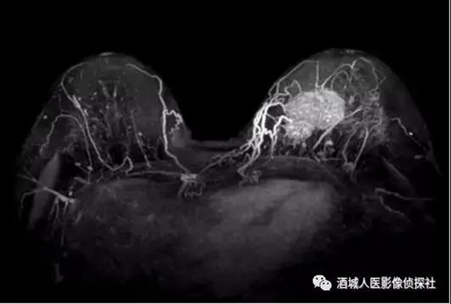 钼靶、超声、磁共振...筛查早期乳腺癌到底该选啥？(图4)
