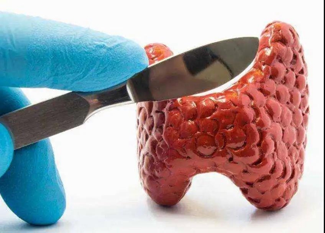 【关注】体检查出甲状腺结节，是癌吗？(图5)