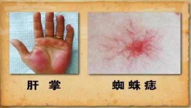 【扩散】肝癌患者注意，西南医大中医院可免费治疗！(图7)