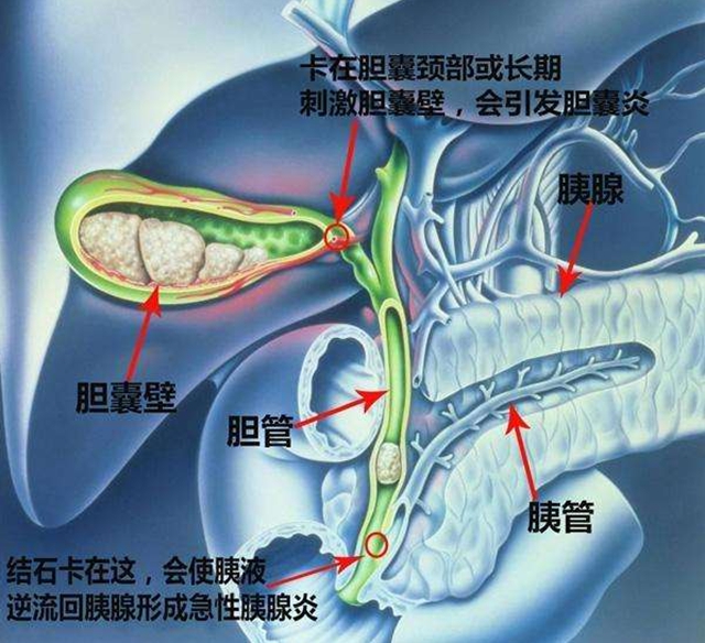 【关注】老是恶心打嗝,竟是胆里长了石头!(图4) 4.jpg