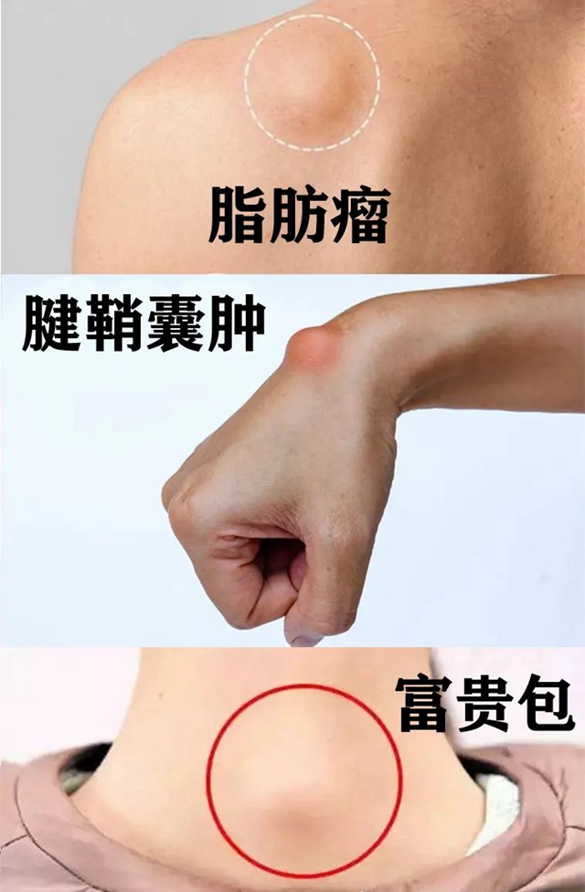 【罕见】泸州36岁男子小腿变粗长包,结果竟是……(图3) 640 (6).jpg