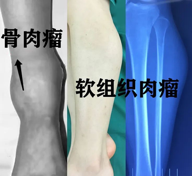 【罕见】泸州36岁男子小腿变粗长包,结果竟是……(图4) 640 (8).jpg