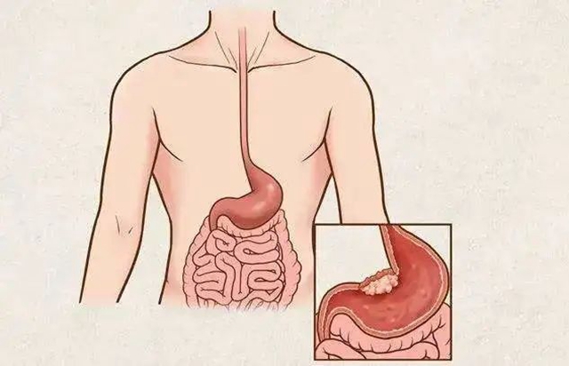 【关注】体检发现腹部包块,竟是……(图2) 2.jpg