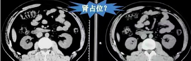 【围观】刚做完CT,医生又让做CT增强,有必要吗?(图4) nEO_IMG_14.jpg