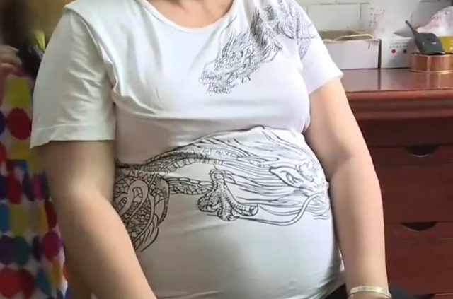 【罕见】女子肚大如10月孕妇，竟是……