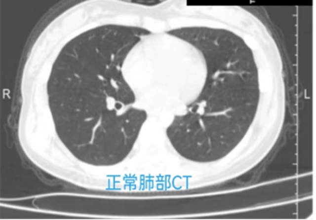 怀疑自己患上“白肺”？先看看这些才知道！
