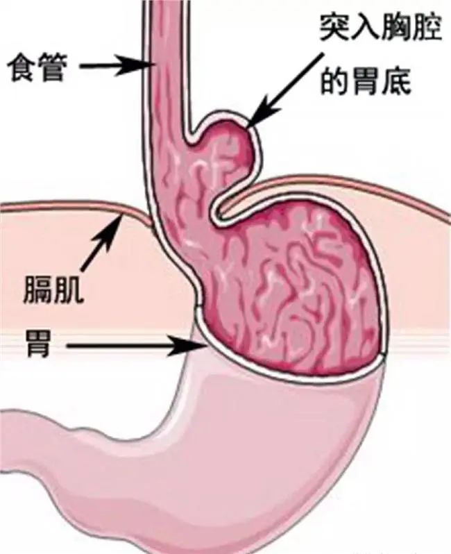 【关注】反复吐酸水、烧心十余年,竟是……(图3) 3.jpg
