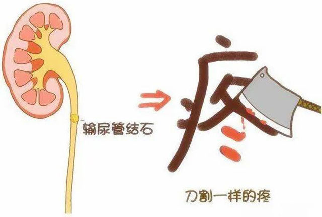 科普丨什么是输尿管软镜技术?(图1) 1.jpg