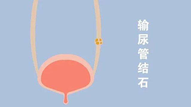 科普丨什么是输尿管软镜技术?(图5) 5.jpg