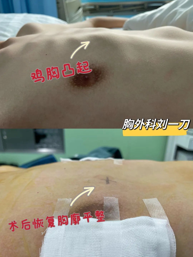 【围观】13岁男孩胸部畸形,一查竟是……(图2) 2.jpg