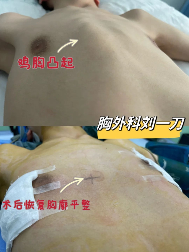 【围观】13岁男孩胸部畸形,一查竟是……(图3) 3.jpg