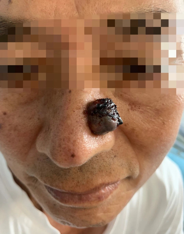 【围观】鼻子上的一颗痘，竟长成癌中之王