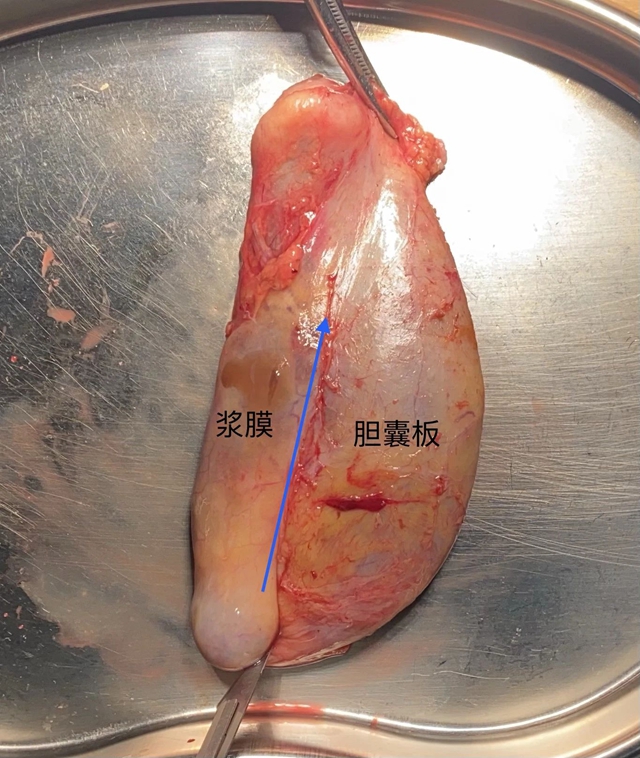 【当心】息肉癌变！专家提醒：这样的要及时切
