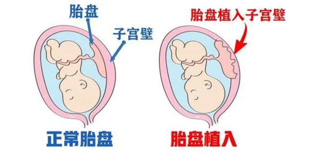 【凶险】罕见的熊猫血孕妇，出血“一滩”......