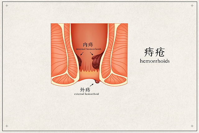 【提醒】错把肠癌当痔疮，耽误了多少性命！大便出现这3个变化，要怀疑肠癌的可能