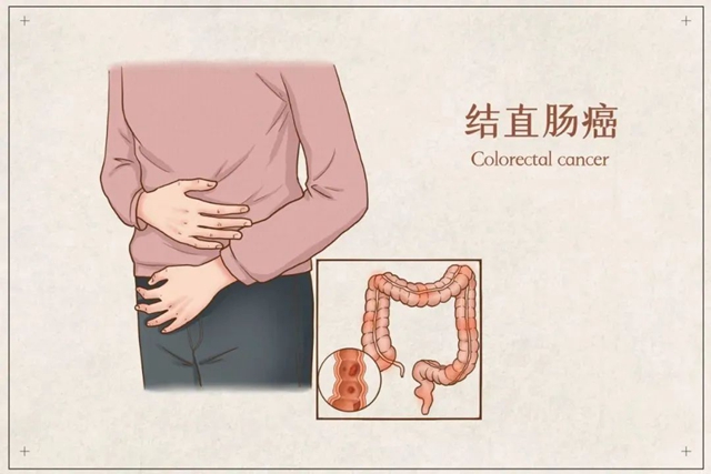 【扩散】30岁泸州小伙患肠癌，大便这些情况，需注意......