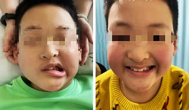 【警惕】10岁小孩面瘫！