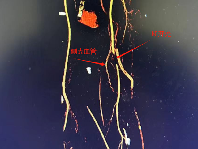 【惊险】摔伤致大出血,硬核男子独自跑回家……(图4) 微信图片_20240307085930.png