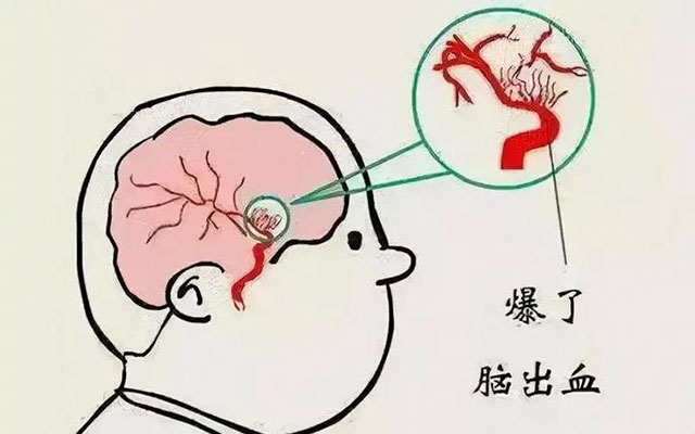 【警惕】泸州女子脑袋里查出3个瘤……(图7) 7.jpg