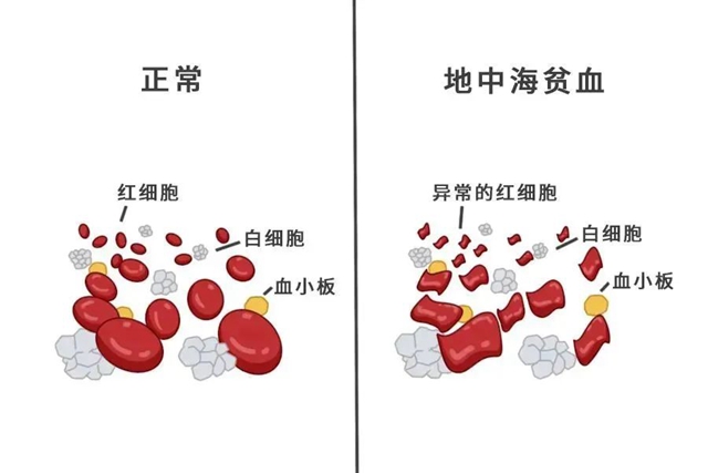 【关注】7岁小女孩每月靠输血维生!这病遗传率 50%!(图3) 微信图片_20240511093318.jpg