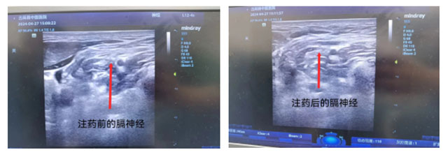 顽固打嗝停不下来？麻醉医师帮您排忧解难！