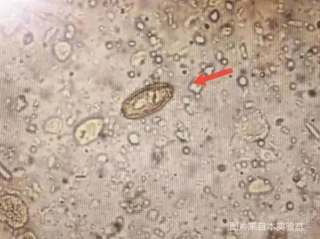 【警惕】很多人爱吃，有寄生虫！医生提醒：这种食物少吃！