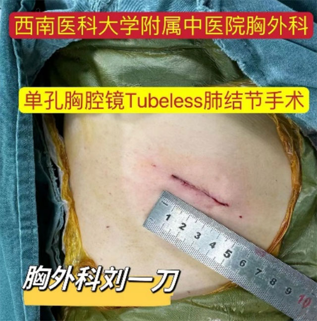 【厉害】肺结节手术，隔天就能出院