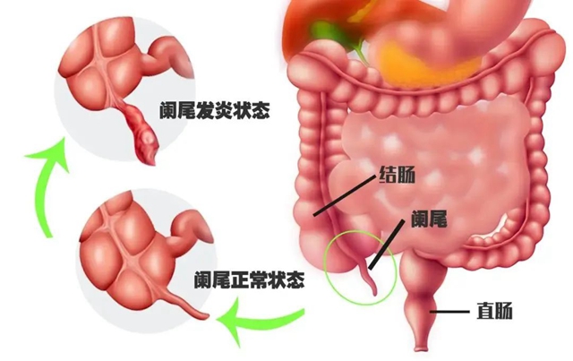【警惕】男子吃西瓜不吐籽，掉进阑尾，结果……