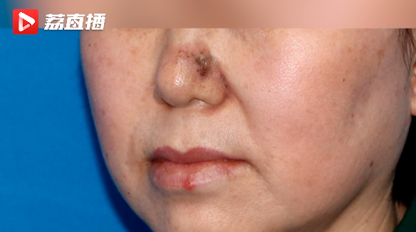 【围观】女子鼻子长“黑头”，一查竟是癌......