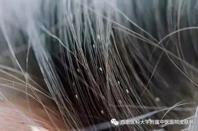 【警惕】靠吸人血为生的小“头虱”，大麻烦！