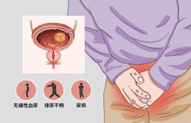 【技术】当膀胱“遇到”癌,别怕!我们能根治它(图4) 4.jpg