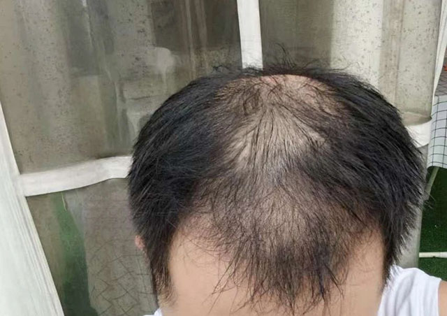 【现身说法】泸州小伙脱发，半个月秃顶，三个月逆袭……
