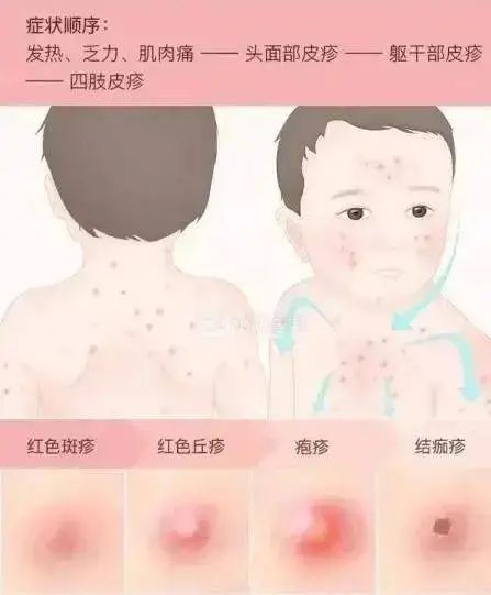 【警惕】多地发现,全班隔离!这种传染病出现新趋势(图3) 水3.jpg
