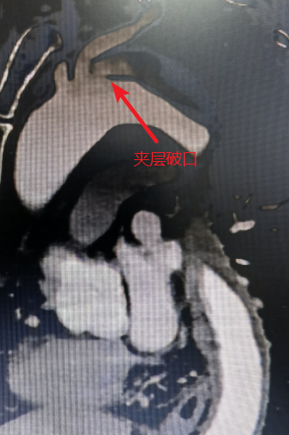 【警惕】冬季高发,男子倒地不起:“痛到像整个人被撕开!”(图2) 动2.png