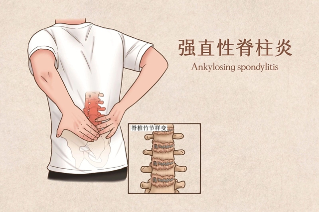 【围观】腰背部疼痛、僵硬……警惕！