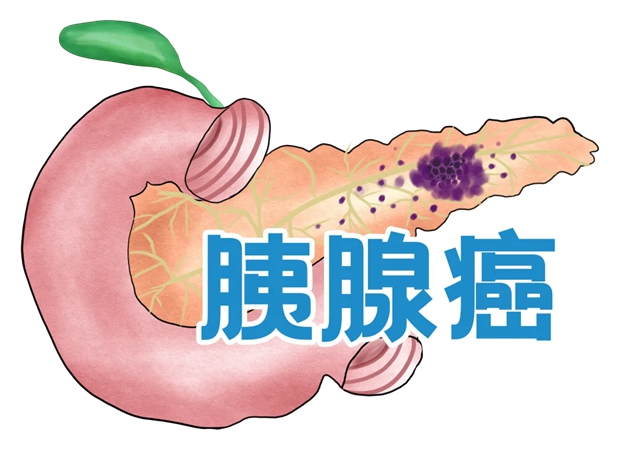 【发现即晚期】确诊到去世仅2个月，癌中之王为什么这么“猛”？小心这些症状