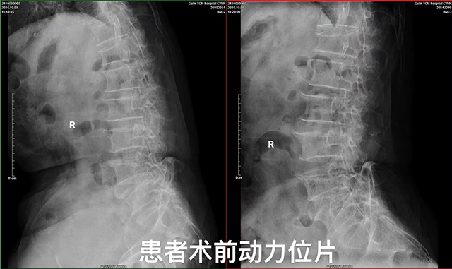 【专科技术】古蔺县中医医院椎间孔镜髓核摘除术：精准祛痛，脊柱微创新希望！