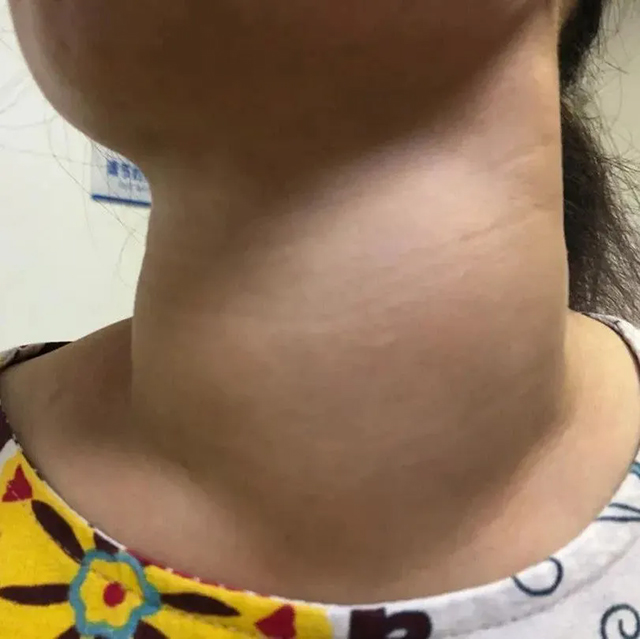 【围观】熬夜熬的是甲状腺寿命！女主播总凌晨睡觉，脖子熬粗了