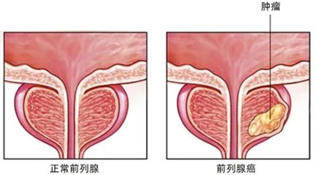 【提醒】父子三人先后确诊同一种癌！医生：早期无可识别症状