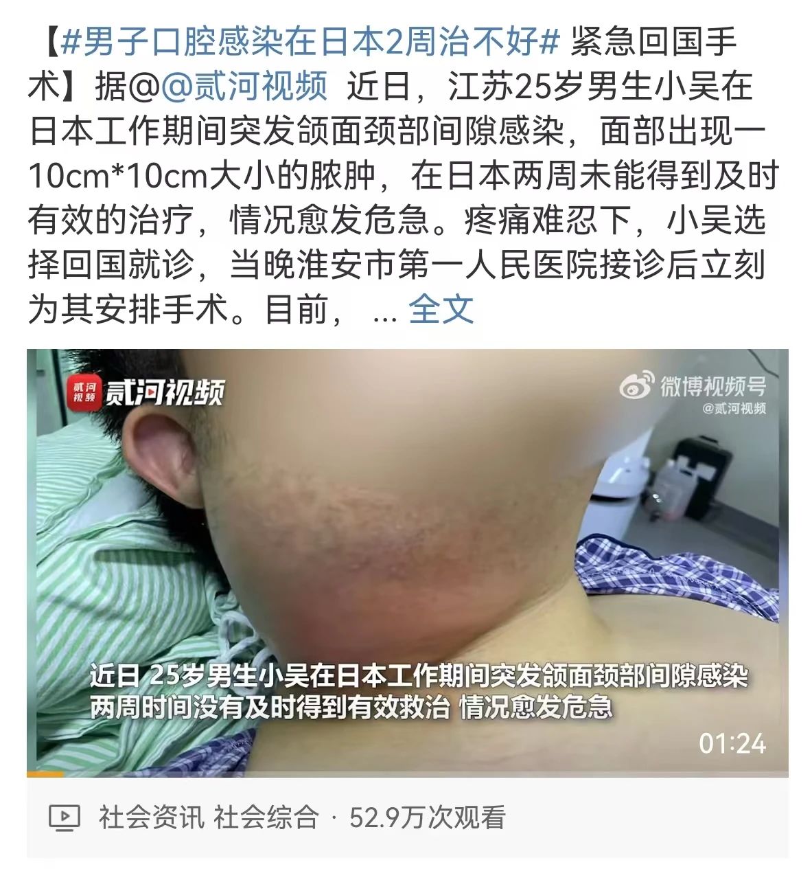 【围观】泸州女子半边脸肿成球！当天“切开”……