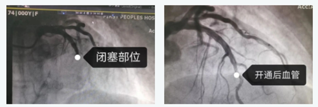 【警惕】1天救治10例,医生提醒:50、60岁患者居多(图4) 4.jpg