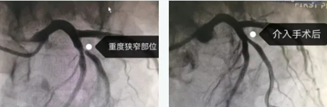 【警惕】1天救治10例,医生提醒:50、60岁患者居多(图2) 2.jpg