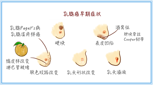 【警惕】25岁姑娘胸部长肿块,一查竟是乳腺癌!医生:和这个习惯有关,很多人都有(图4) 4.jpg