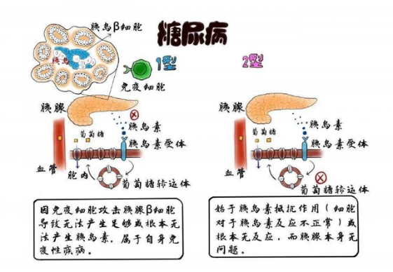 什么?儿童也可能得糖尿病?(图3) 3.png