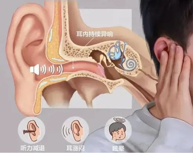 年轻人,别让“耳鸣”成为青春噪音——当代青年的听力保卫战!(图2) 2.jpg