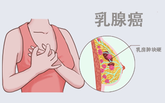 【警惕】每26秒就有一人确诊乳腺癌，如何为乳房“松绑”？